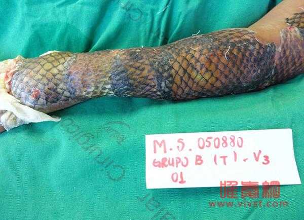 巴西女子手臂烧伤后植入鱼皮 有望快速恢复
